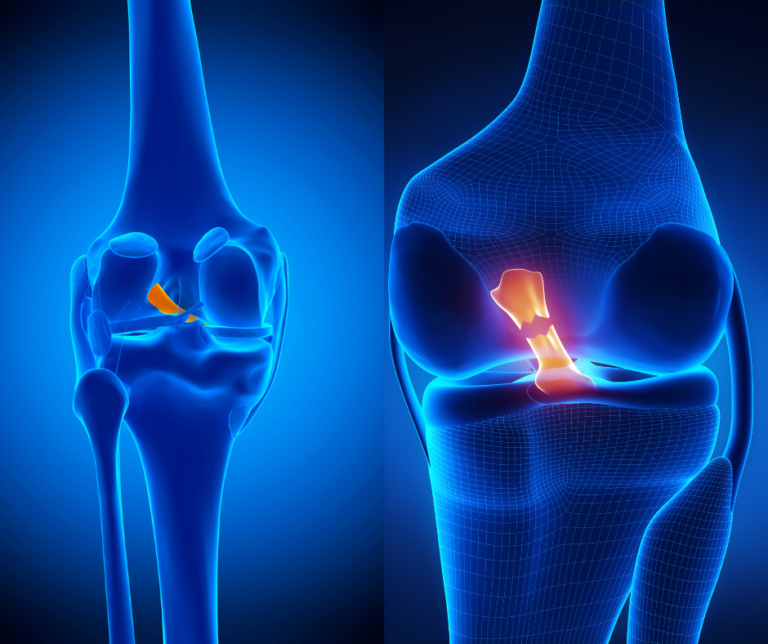Knee with intact anterior cruciate ligament and knee with torn anterior cruciate ligament